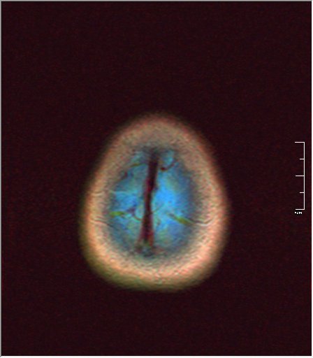 File:Brain MRI 0076 00.jpg