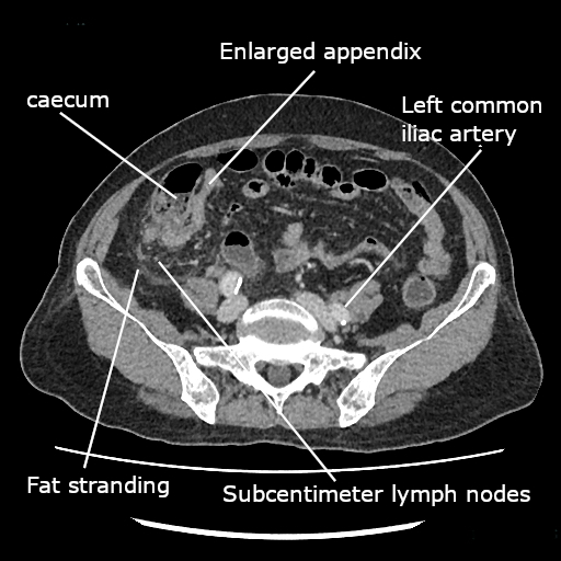 CT scan of the abdomen showing acute appendicitis