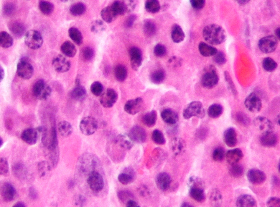 Neoplasias de celulas b maduras