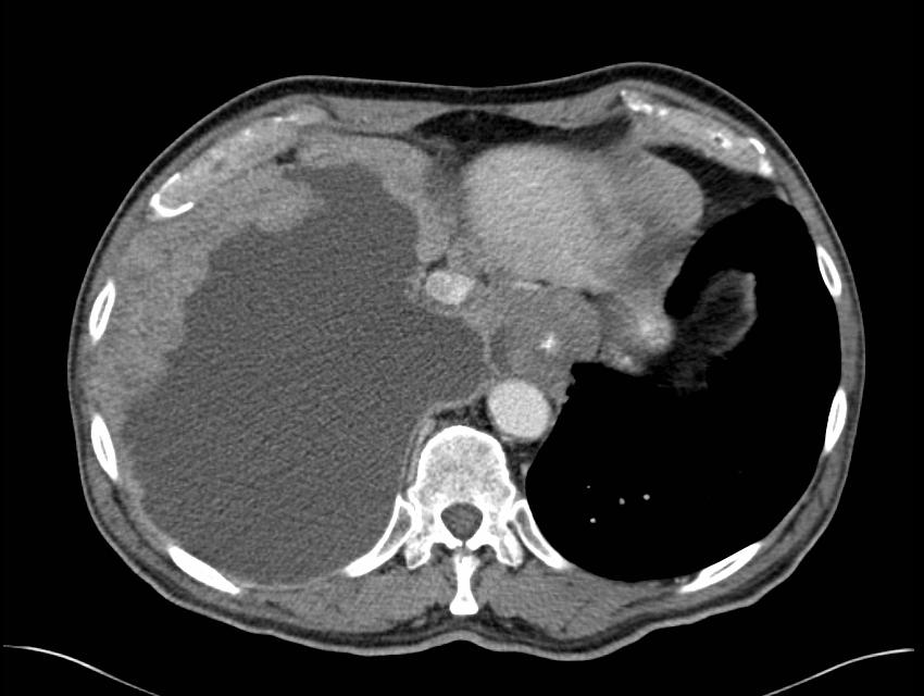 malignant mesothelioma ihc marker