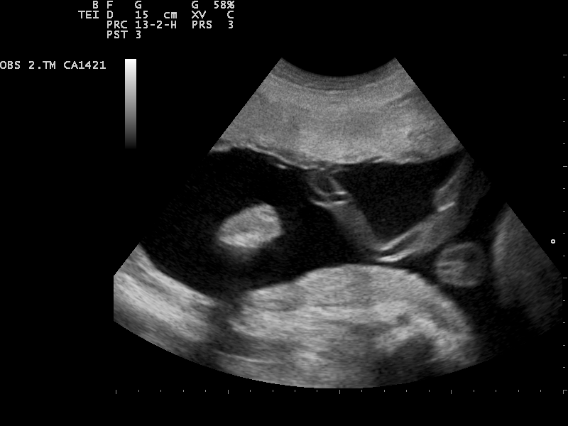 File:Ultrasound Scan ND 0124092323 0930041.png