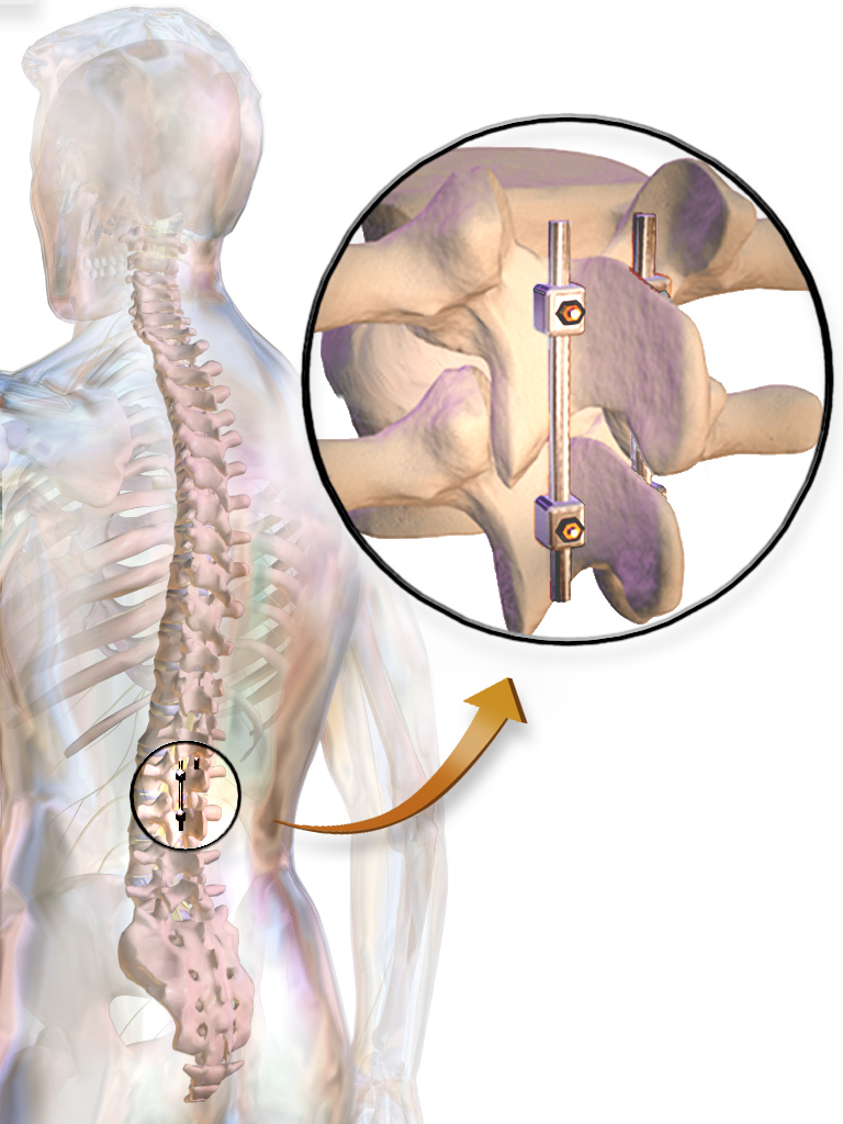 This is an image of a spinal fusion surgery with screws helping to hold the vertebrae together