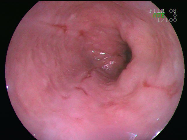 Esophageal ulcer