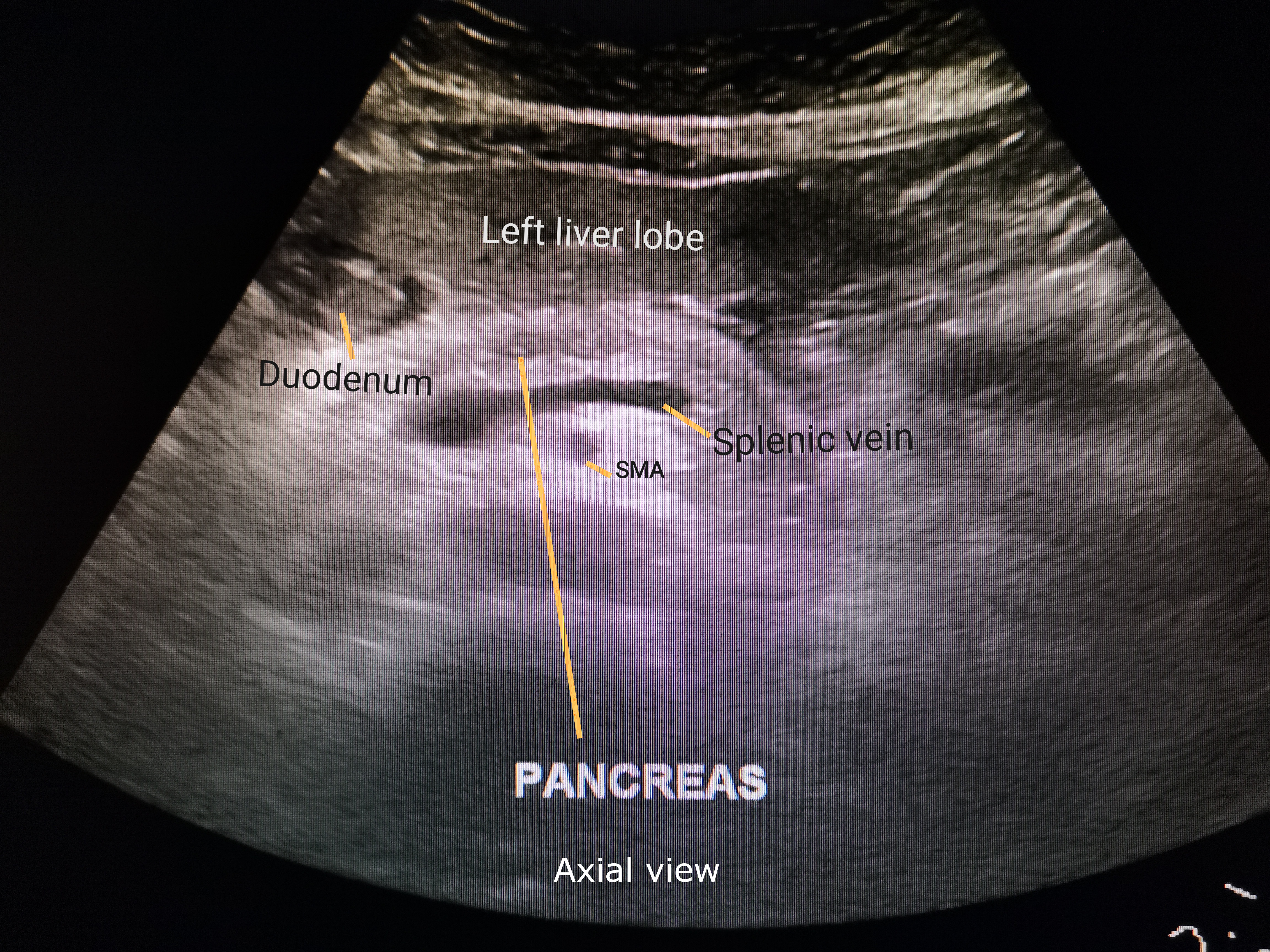 pancreas ultrasound