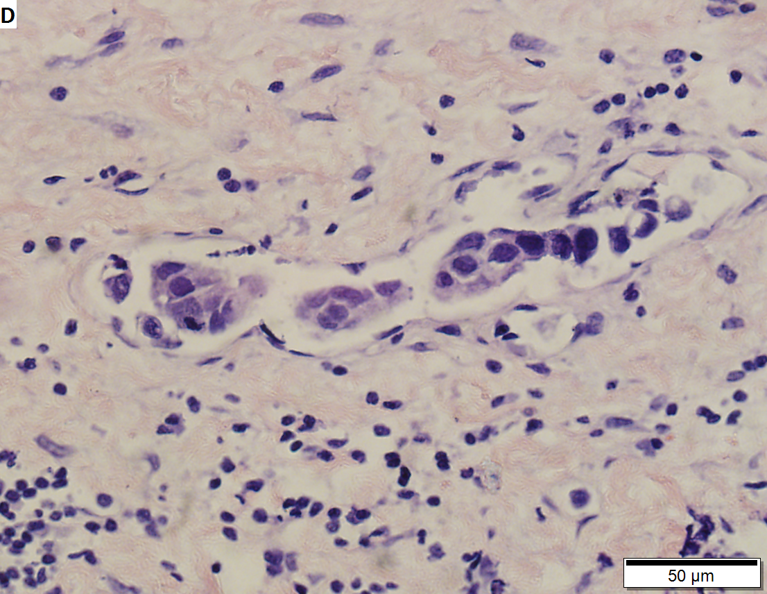 High grade urothelial carcinoma