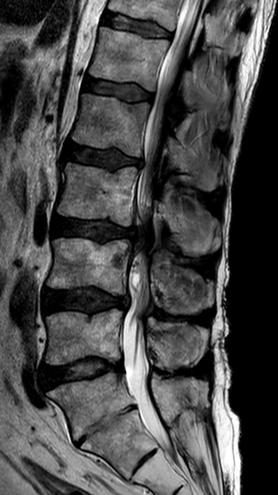 Lumbar spinal stenosis - Wikipedia