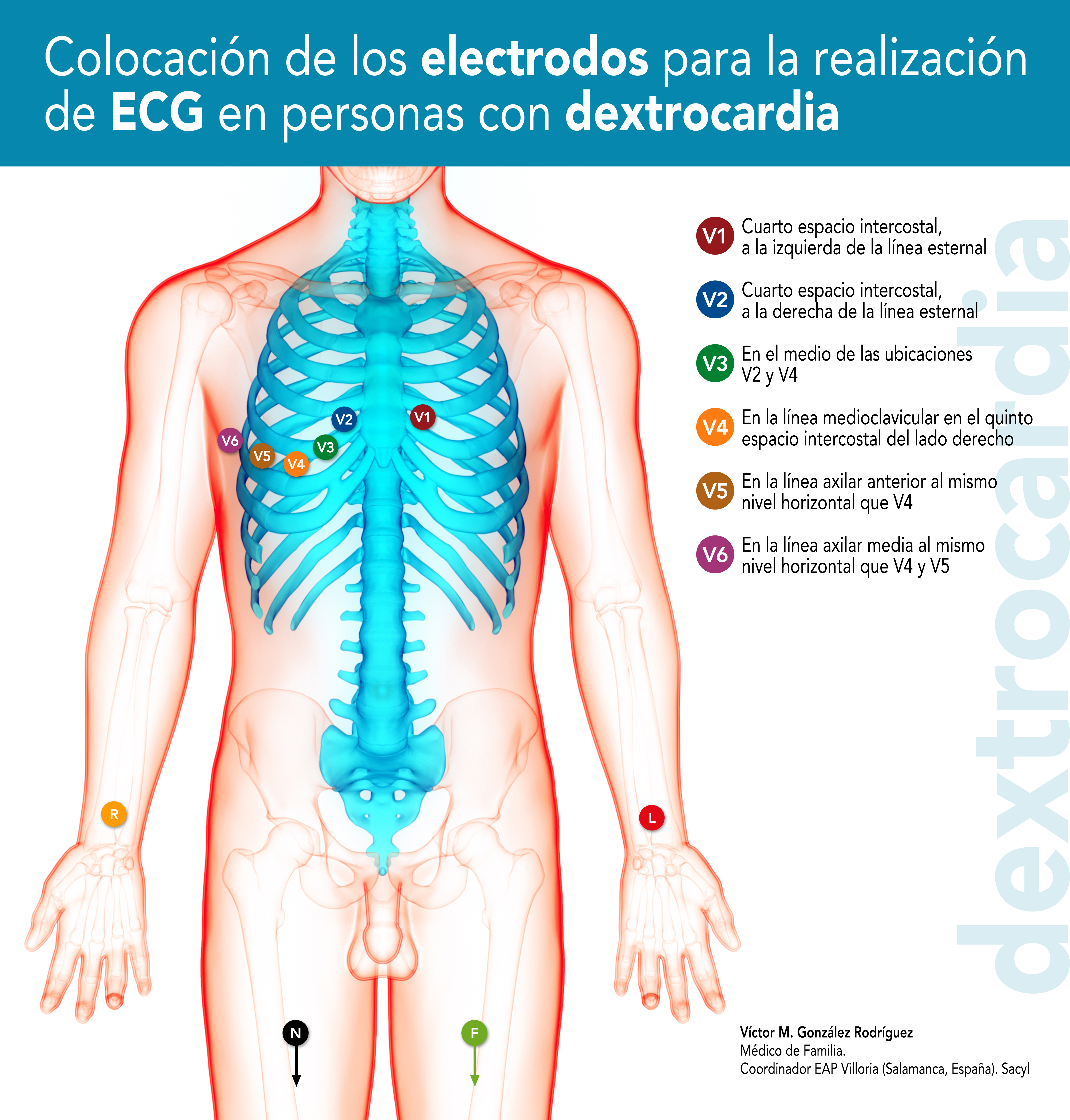 Aturdir punto claridad File:Colocación Electrodos ECG en Personas con Dextrocardia.jpg - Wikimedia  Commons