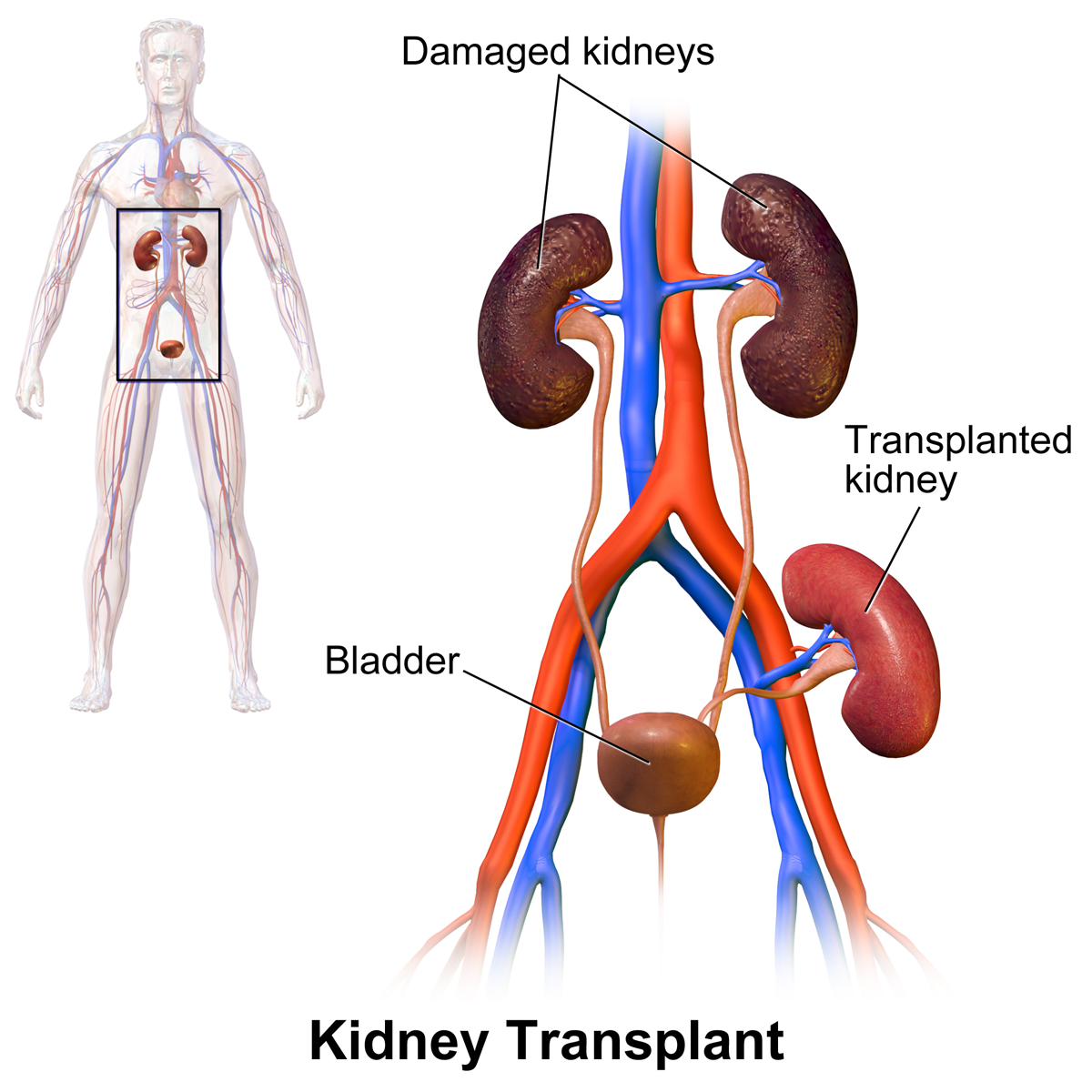 FileKidney Transplant.png   Wikimedia Commons