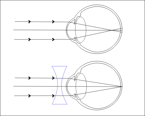 File:Myopia.png