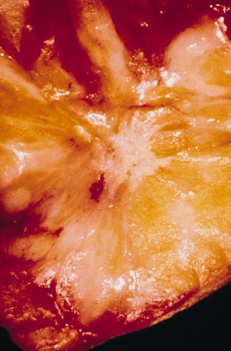 File:Radial scar.jpg