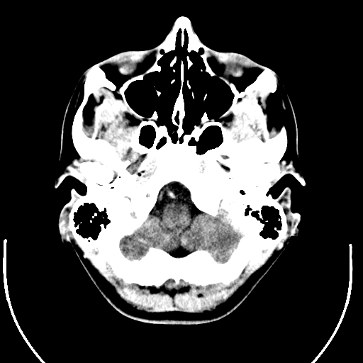 Computed tomography of human brain (3).png