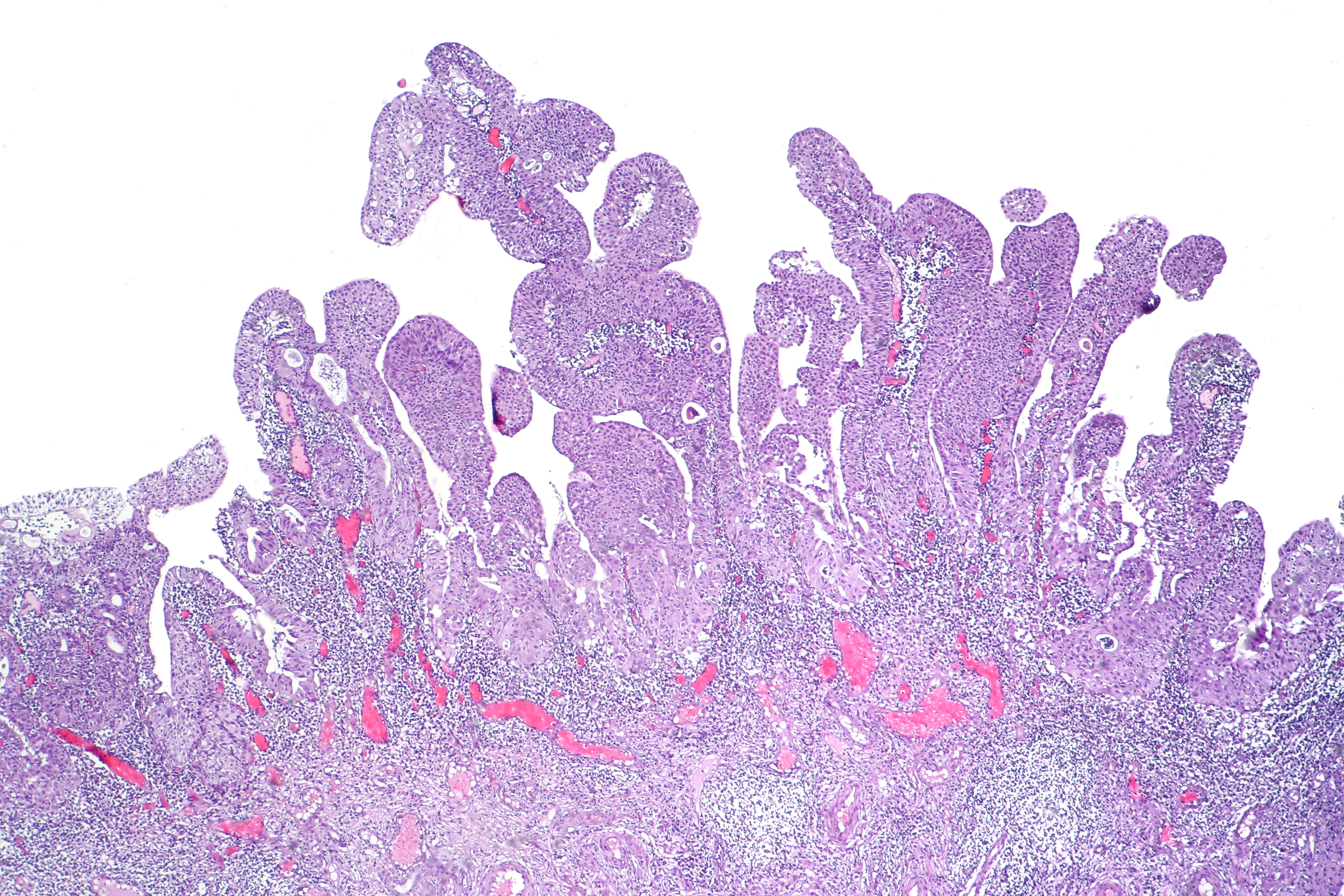 exophytic papilloma of bladder