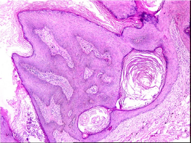 File:Histopathology of seborrheic keratosis.jpg