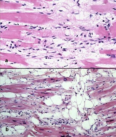 File:Arrhythmogenic right ventricular cardiomyopathy - histology.jpg