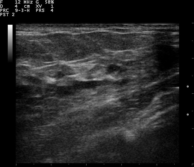 File:Breast ultrasound 110322152418 1524570.jpg