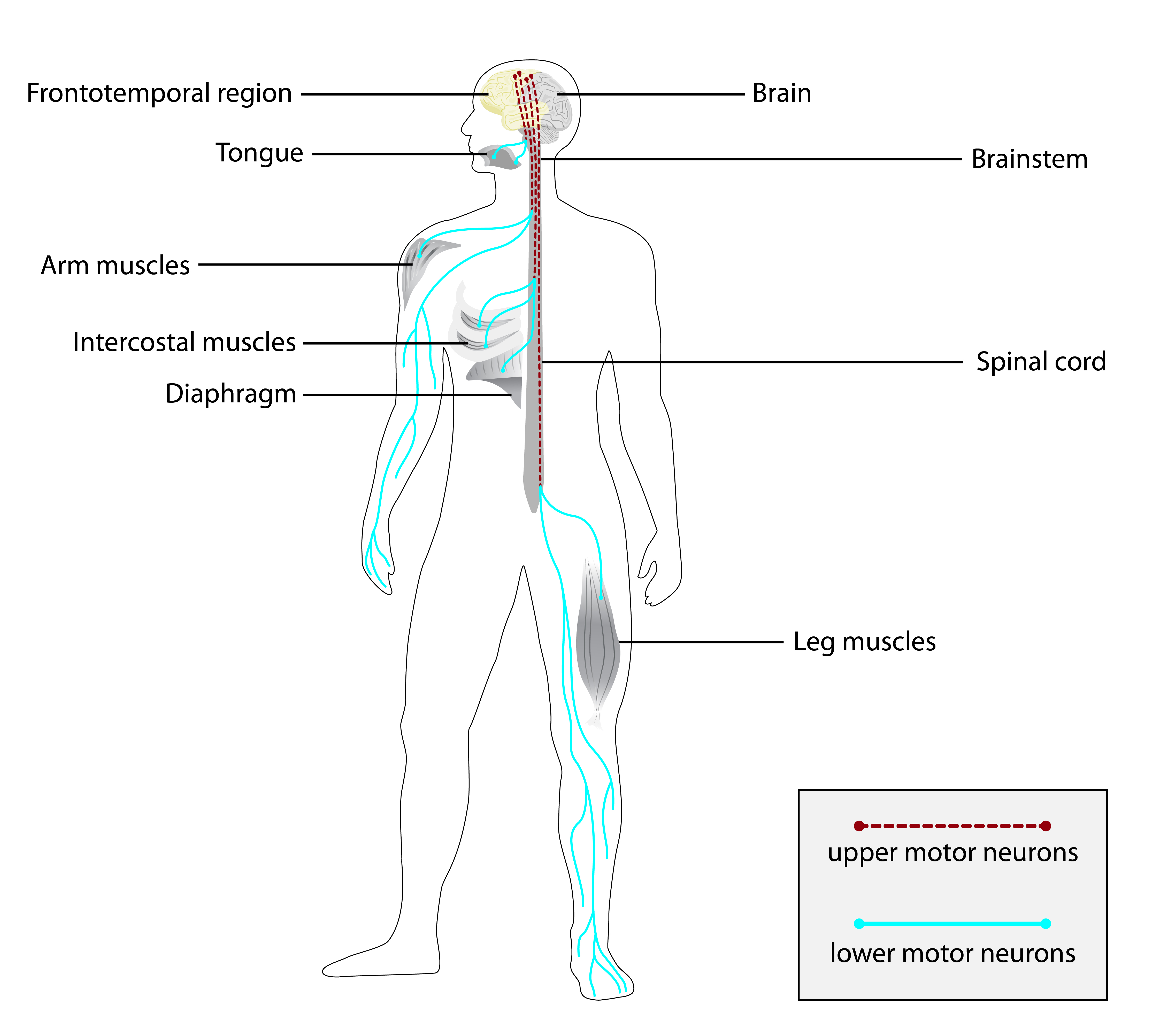 Development of the Myasthenia Gravis (MG) Symptoms PRO: a case study of a  patient-centred outcome measure in rare disease, Orphanet Journal of Rare  Diseases