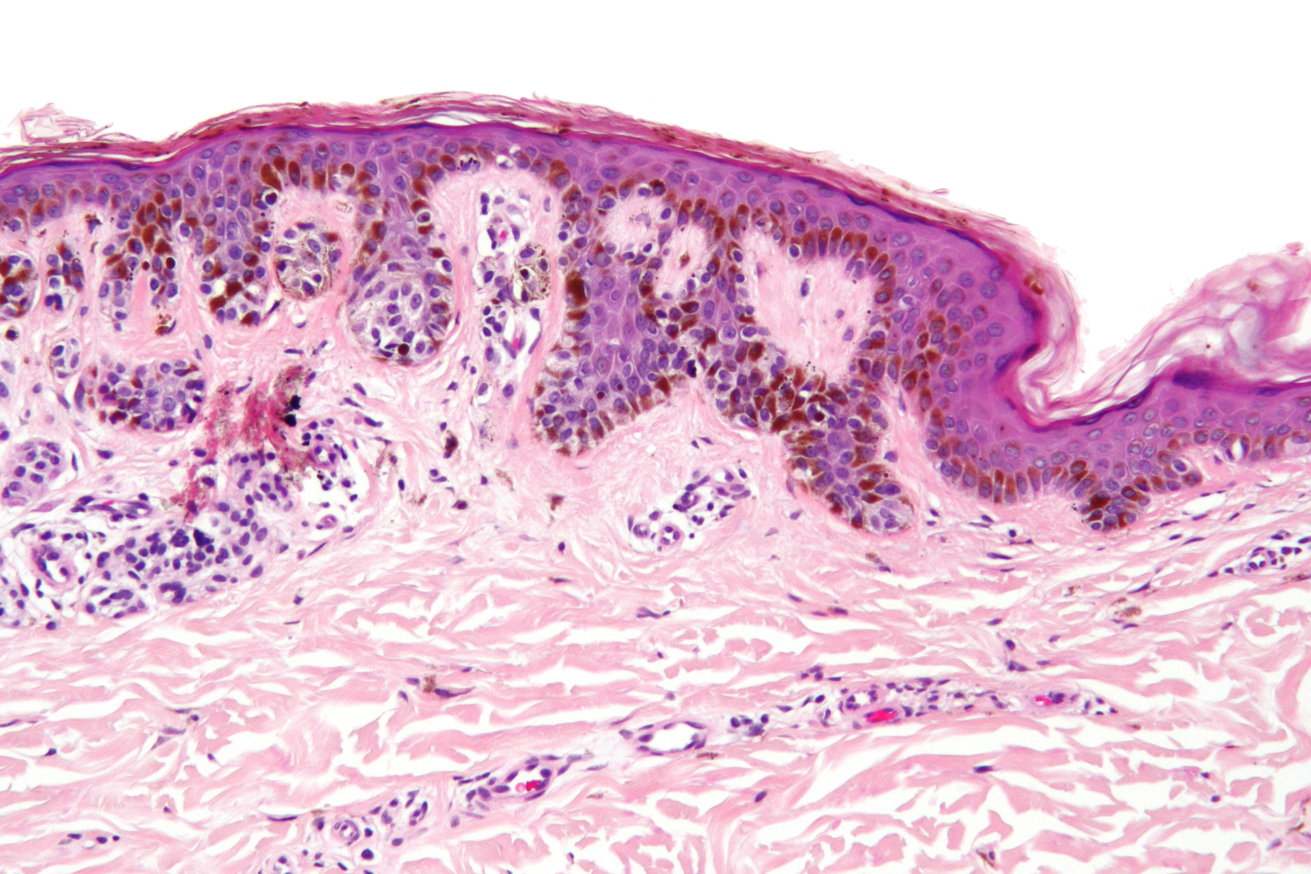 junctional nevus foot