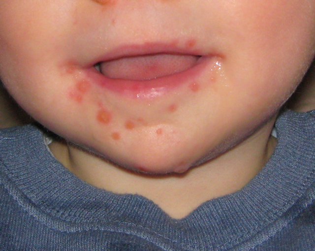 hand foot mouth disease pictures #10