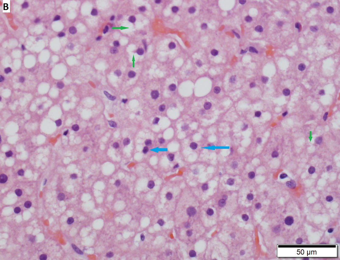 Cirrhosis with steatohepatitis in a 54 year old man