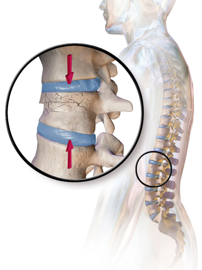 spinal compression fracture from fall