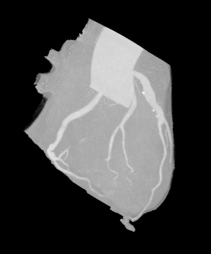 File:Coronaraneursymen bei Kawasaki-Syndrom - CT - Rekonstruktion - MIP - 009.jpg