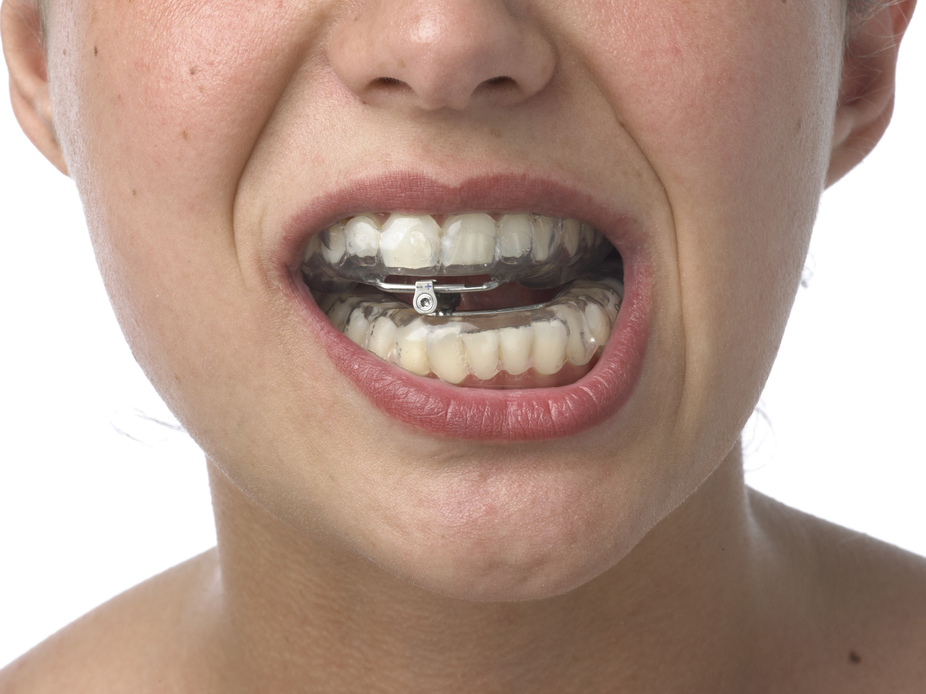 File:Dispositivo de avance mandibular Orthoapnea.jpg - Wikimedia