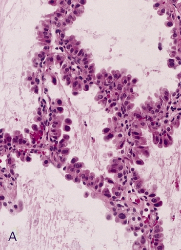 File:Nonmucinous bronchioloalveolar carcinoma.jpg