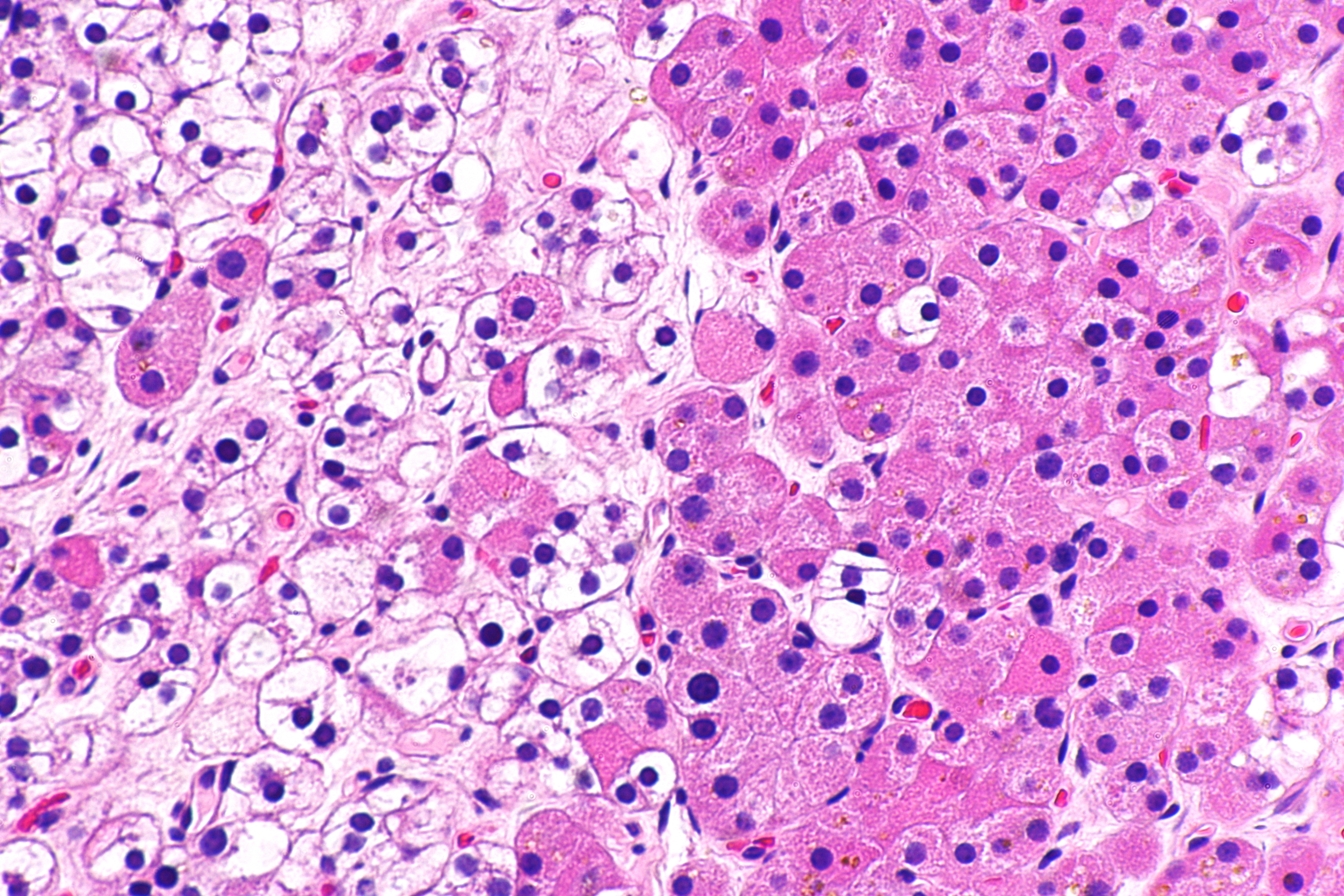 parathyroid adenoma