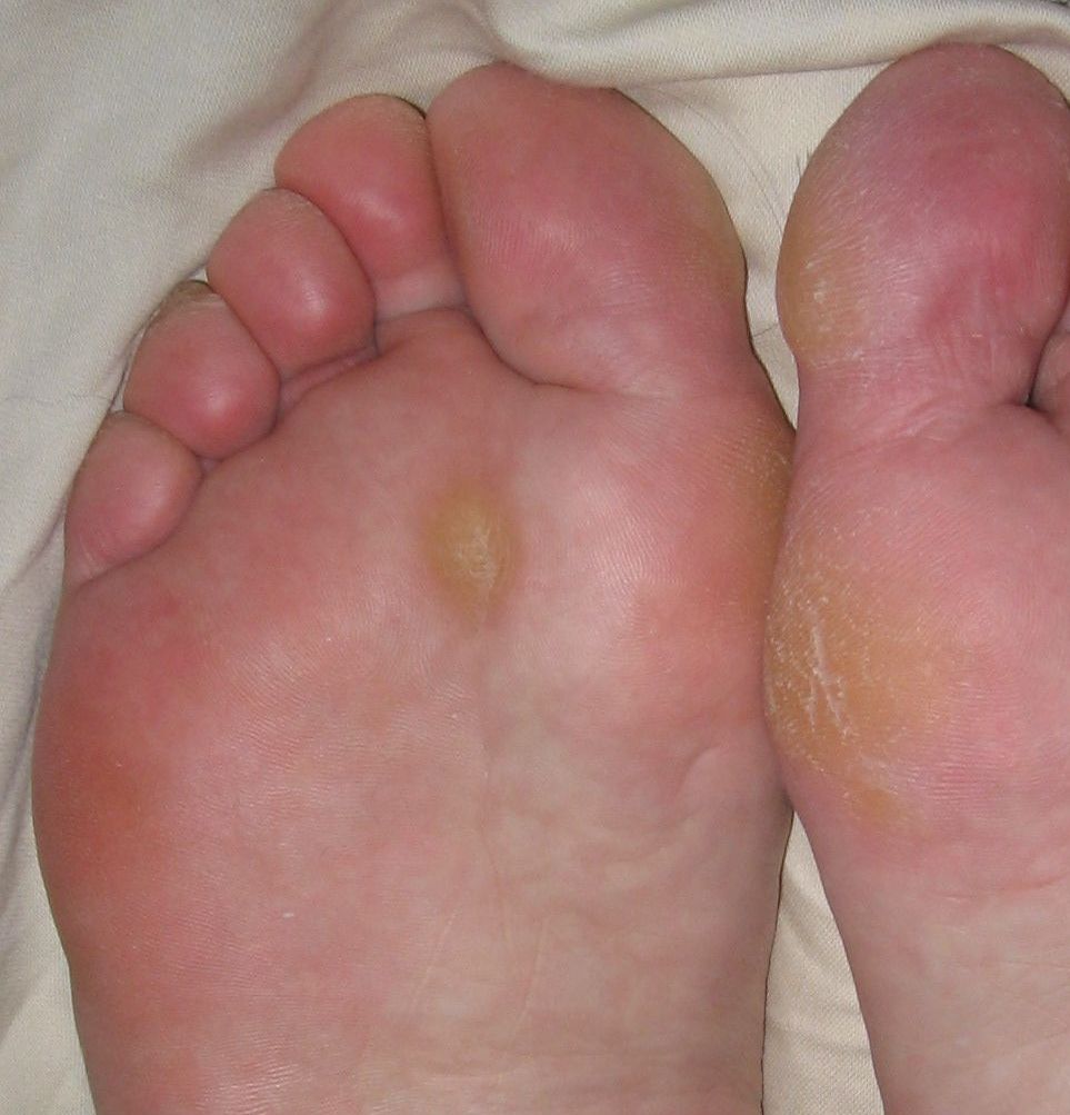 Dead Skin Under Feet: Causes, Symptoms, And Treatment