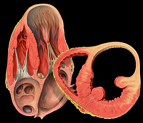 File:Heart ventricular aneurysm views.jpg