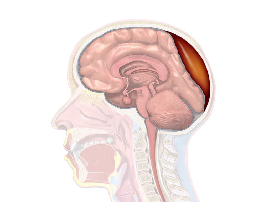 Craniotomy for cerebral shunt: MedlinePlus Medical Encyclopedia Image