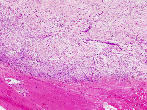 File:Nodular fasciitis (1).JPG