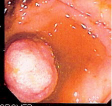Endoscopic image of polyp in small bowel detected on double-balloon enteroscopy