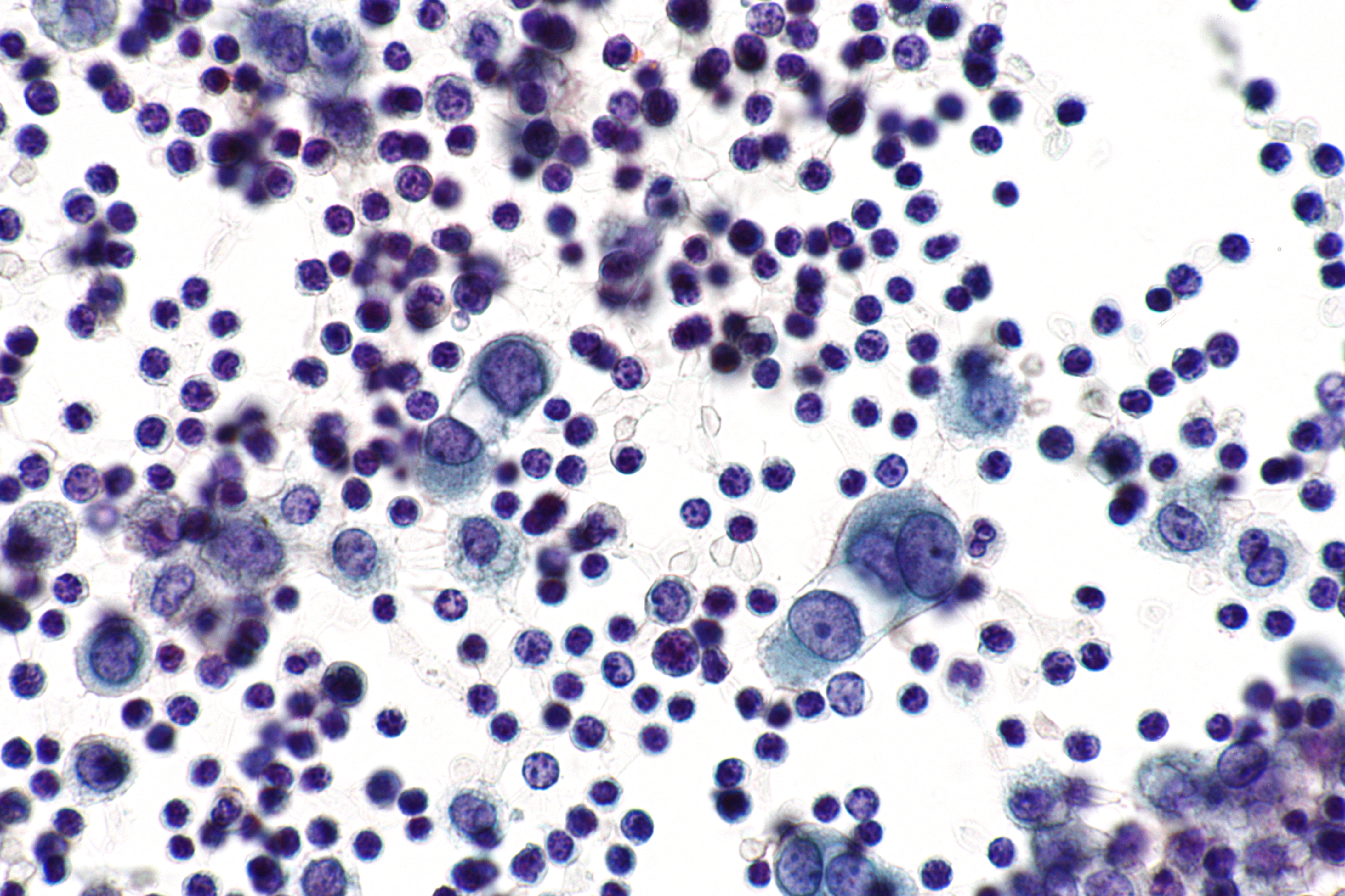 malignant diffuse mesothelioma