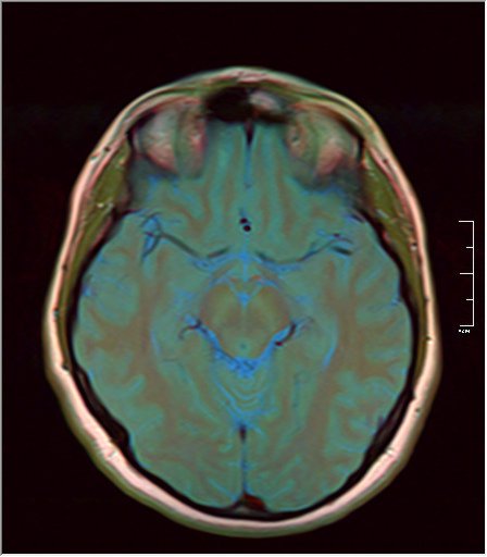 File:Brain MRI 12.jpg