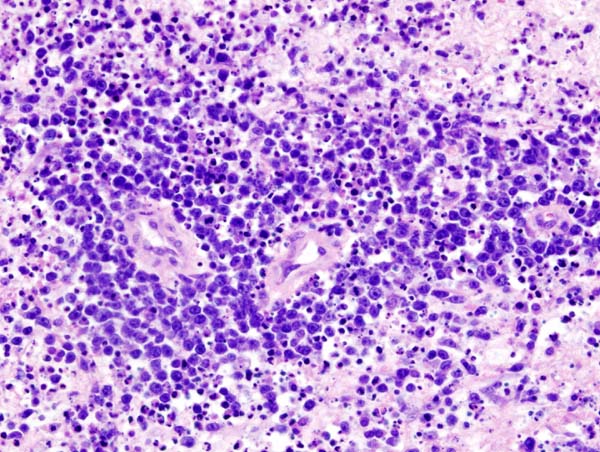 File:CNS lymphoma (1) B-cell type.jpg