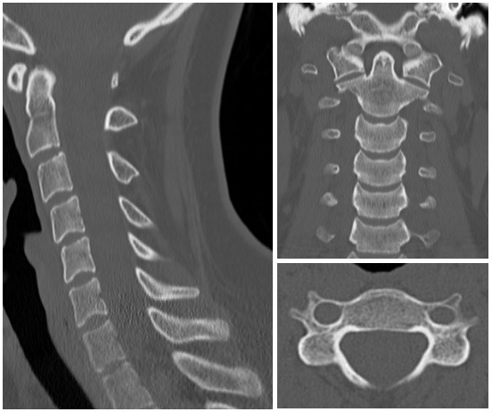 Cervical spine CT scan