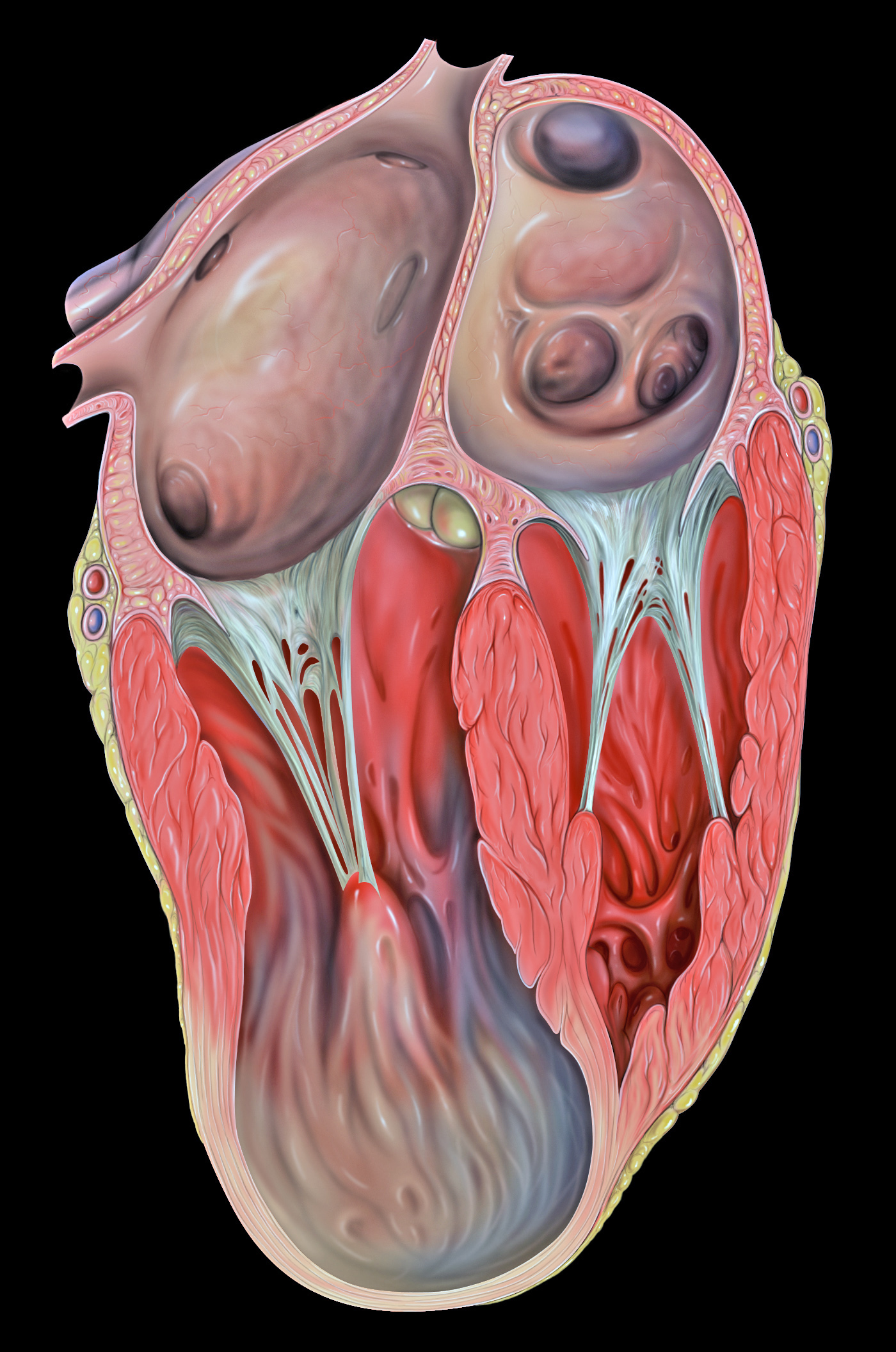 File:Heart lv aneurysm www.neverfullbag.com - Wikimedia Commons