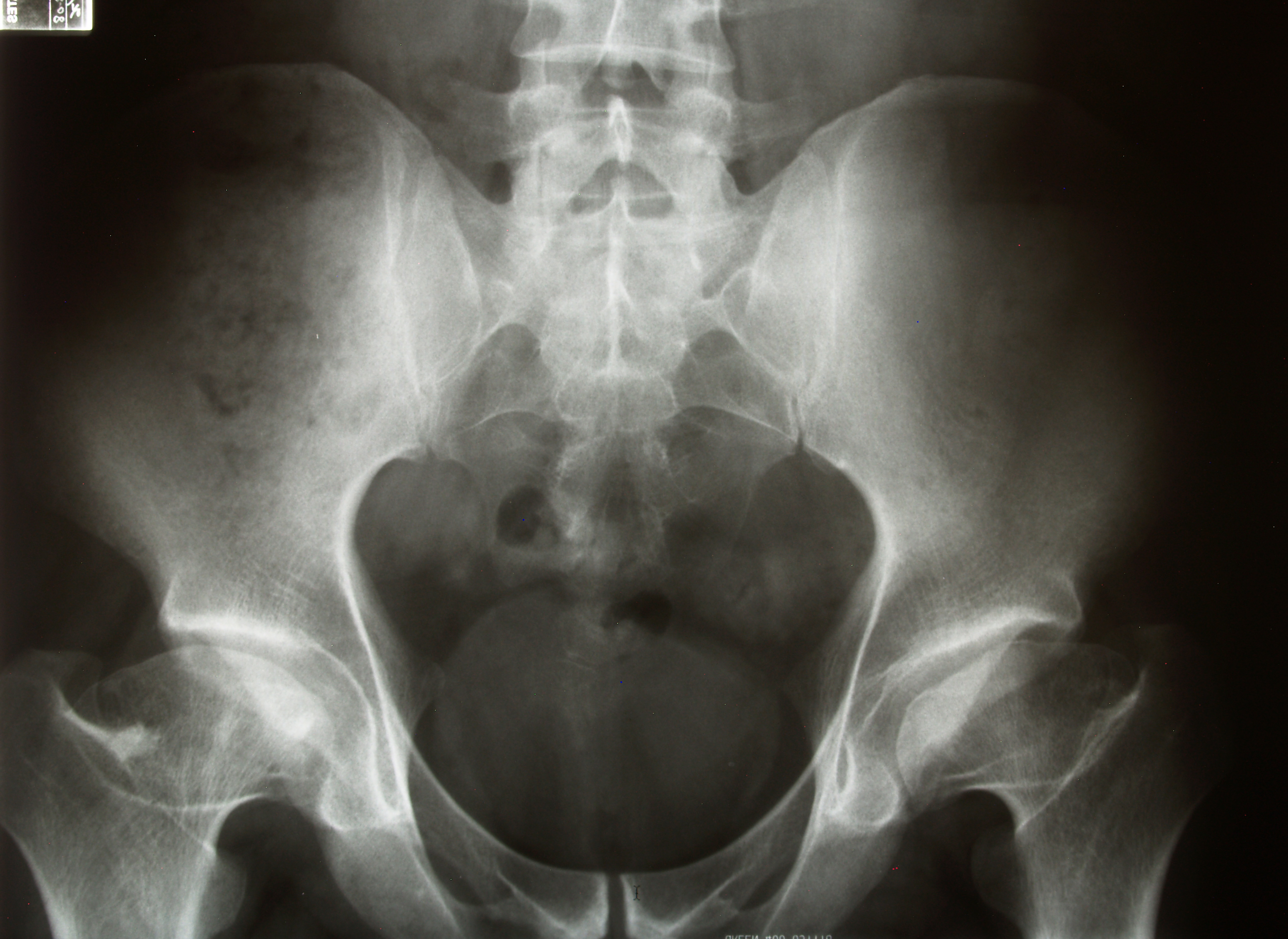 Bilateral avascular necrosis of both femoral heads in Perthes disease