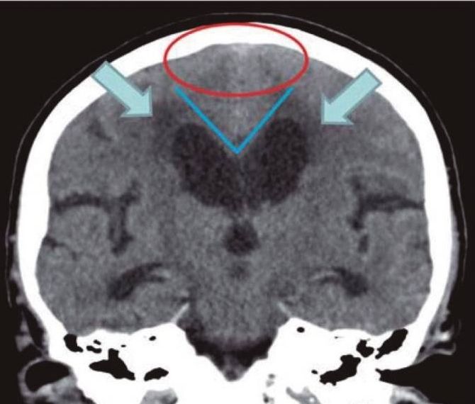 File:Normal pressure hydrocephalus versus atrophy, NPH.jpg