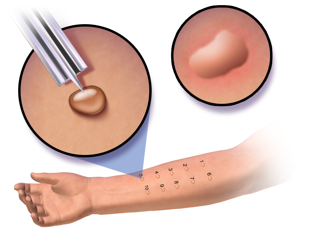 https://upload.wikimedia.org/wikipedia/commons/1/1a/Skin_Prick_Test.png