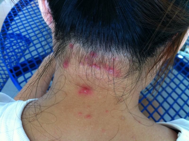 File:Folliculitis at the back of hair scalp which also spread to upper part of the back body.jpeg