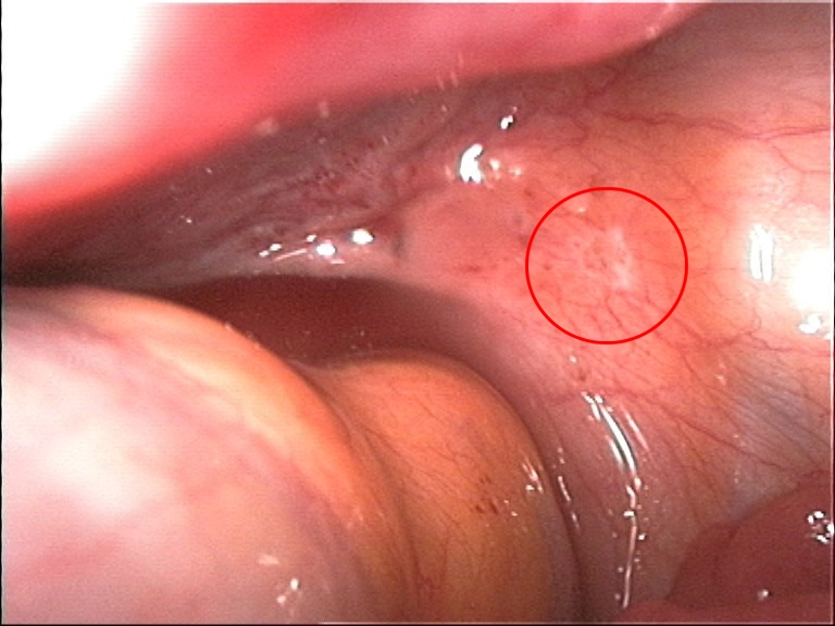 File:White endometriosis.jpg