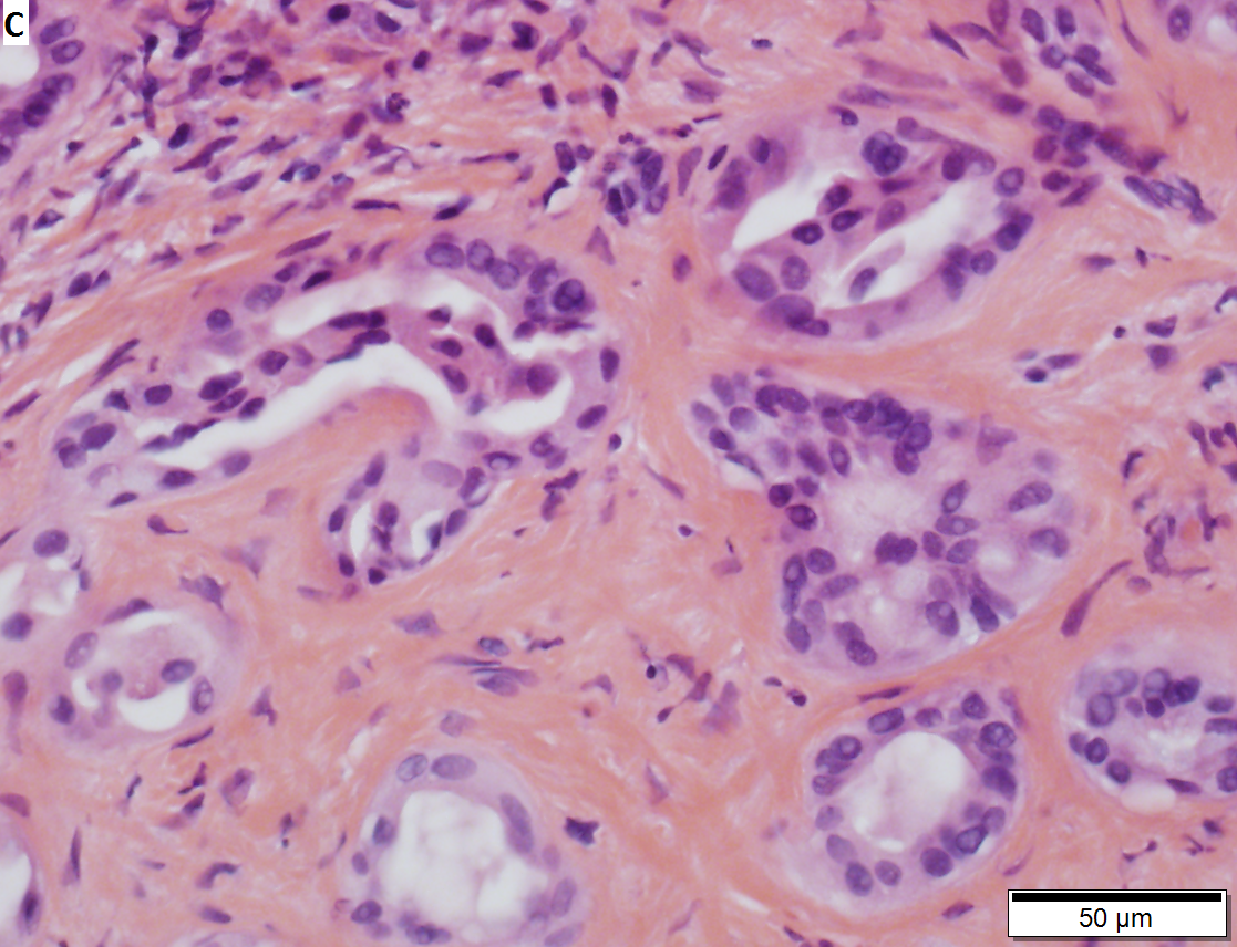 Bile duct adenoma