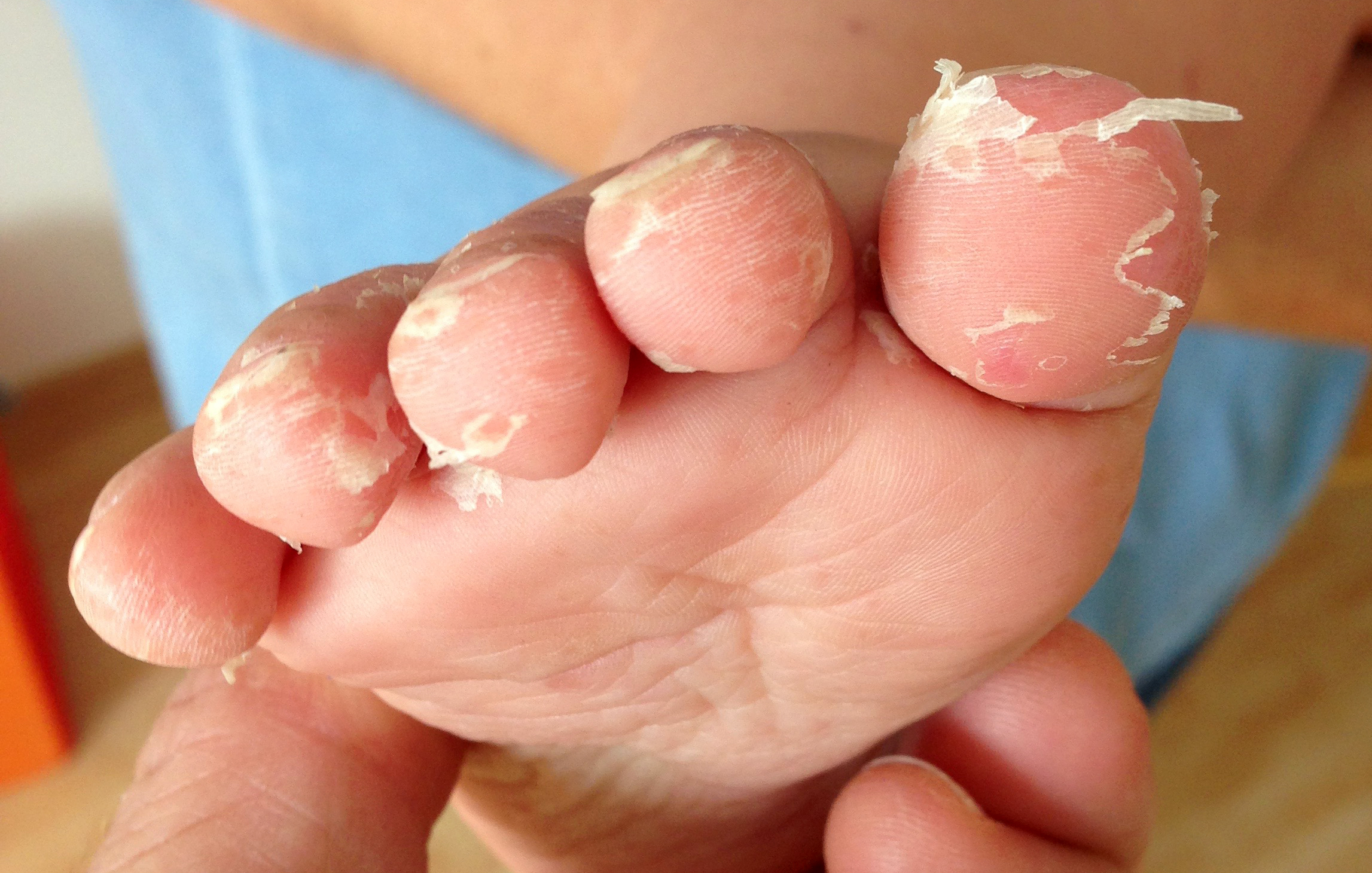 File Desquamation Of The Toes Following A Hand Foot And Mouth Disease 1 Jpg Wikimedia Commons
