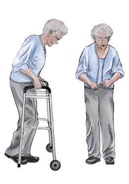 <span class="mw-page-title-main">Signs and symptoms of Parkinson's disease</span> Signs and symptoms