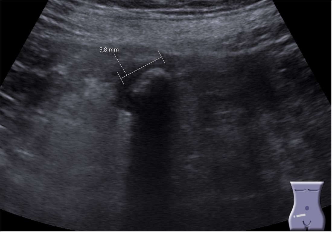 appendicolith ultrasound