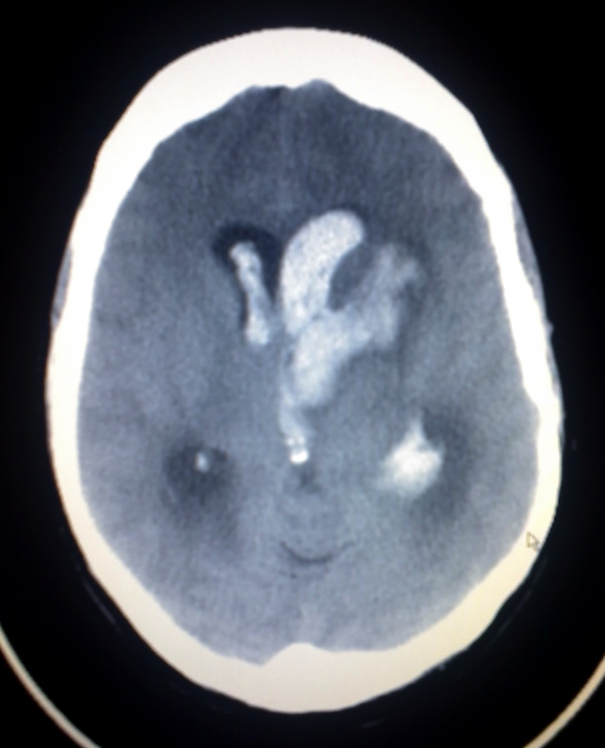 intracerebral hemorrhage locations