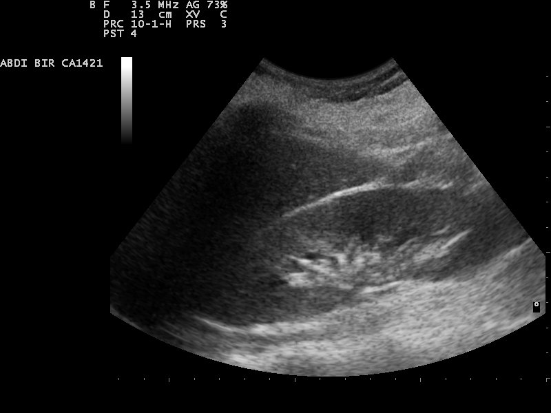 File:Kidney ultrasound 110322090904 0912150.jpg