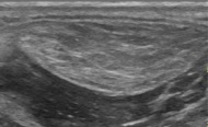 Medical ultrasonography of a lipoma in the thenar eminence: It is hyperechoic compared to adjacent muscle, and relatively well-defined, with miniature hyperechoic lines.[23]